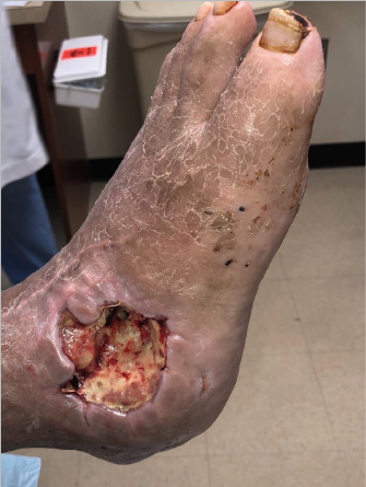 Figure 1. Chronic DFU greater than 2 years (08/13/19).