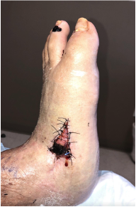 Figure 2. One week post V to Y advancement flap (09/17/20).