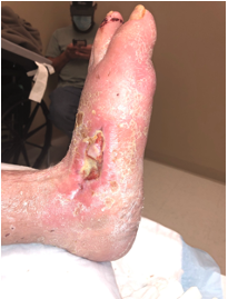 Figure 3. Seven weeks post V to Y advancement flap (11/3/20).