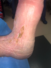 Figure 4. Regression of V to Y advancement flap (1/21/21).