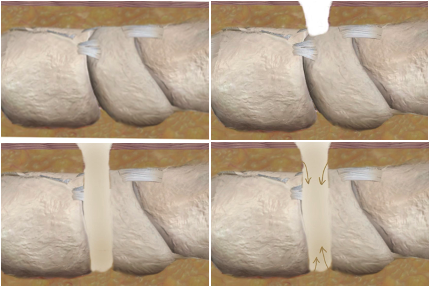 Figure 5a. Intact cortex. Figure 5b. Wound with exposed bone. Figure 5c. Bicortical trephination. Figure 5d. Ingrowth of granulation tissue.