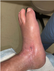 Figure 7. Nine months post bicortical trephination procedure with application of allograft (10/14/21). 