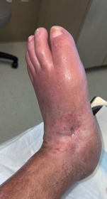 Figure 8. Ten months post bicortical trephination procedure with complete epithelialization of wound (11/16/21).