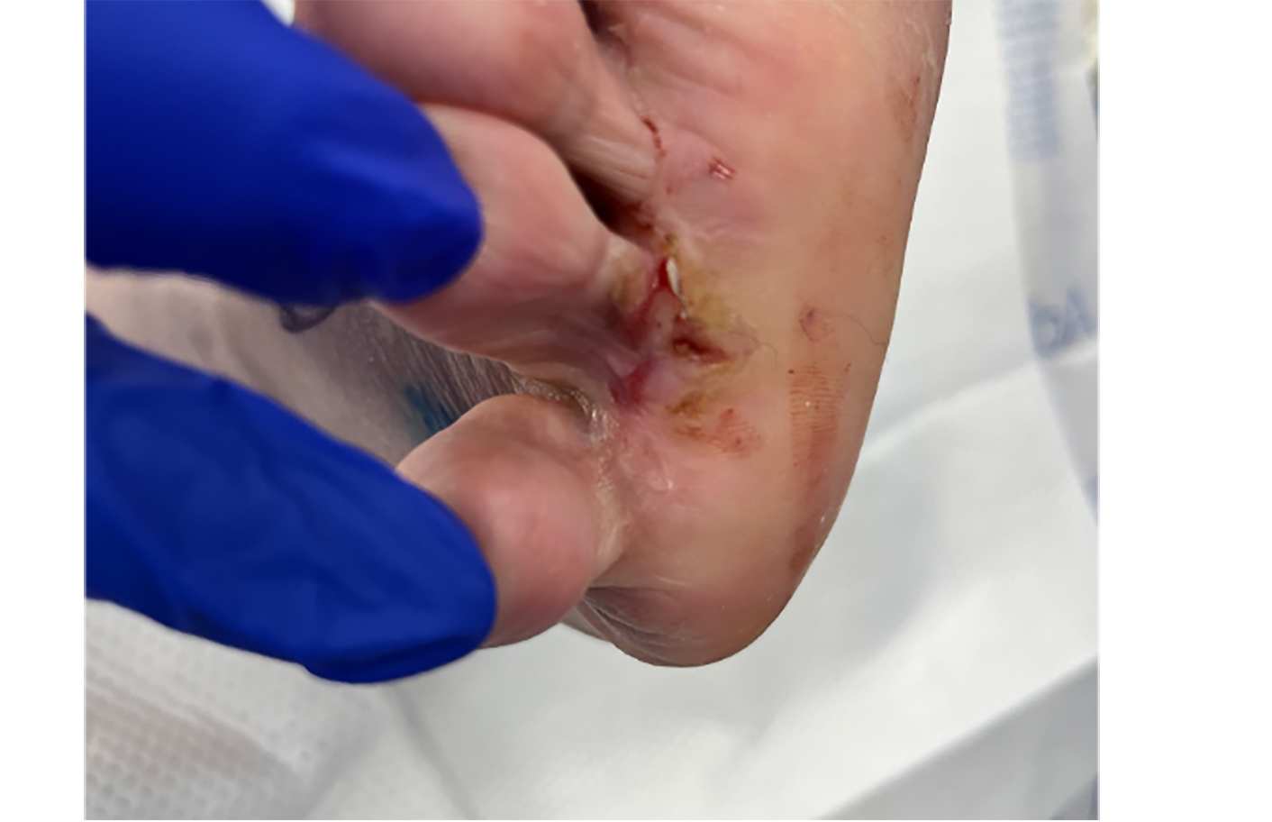 Figure 1. The lesion of concern initially appeared as a hyperkeratotic fissure to the plantar right fourth digital sulcus. 