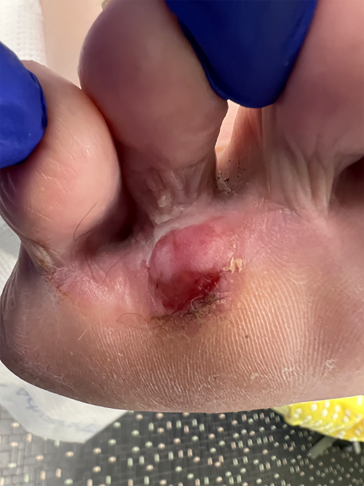 Figure 2. One year later, one can see an increased granular base and adjacent hypopigmentation. 