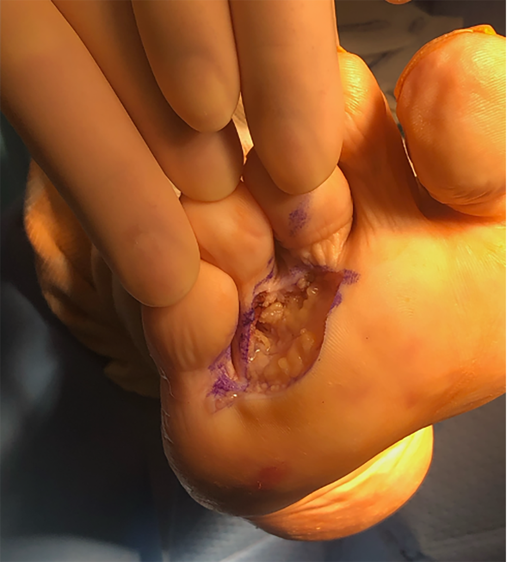 Figure 3. After oncology referral, the patient underwent another wide excision, this time with a concurrent inguinal node biopsy.