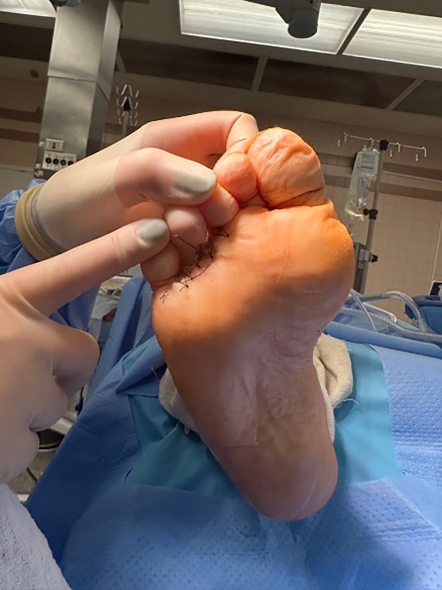 Figure 4. The wide excision was closed primarily, as seen in this photo.