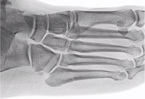 Figures 1. The majority of Jones fractures, as seen above, by definition will occur in the proximal diaphysis between zones II and III.