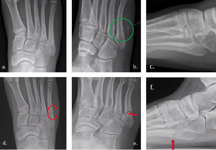 Figures 2. a-c Example of an acute Jones fracture. d. X-ray 6 weeks post-injury, often diagnosed as  stress fracture based on bone callus e. Bone resorption at 6 weeks, seen here, can be misdiagnosed as a non-healing fracture f. It is critical to see a perfect lateral X-ray view to identify the plantar cortex of the fracture.