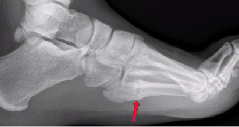 Figure 3. This image shows a fracture 3 months post-injury misdiagnosed as a nonunion. The fracture is healing, but not healed. The trainee was pain-free, but should not train until the lateral view shows further consolidation due to high risk of refracture. If pain was present, the author recommends intramedullary screw fixation.