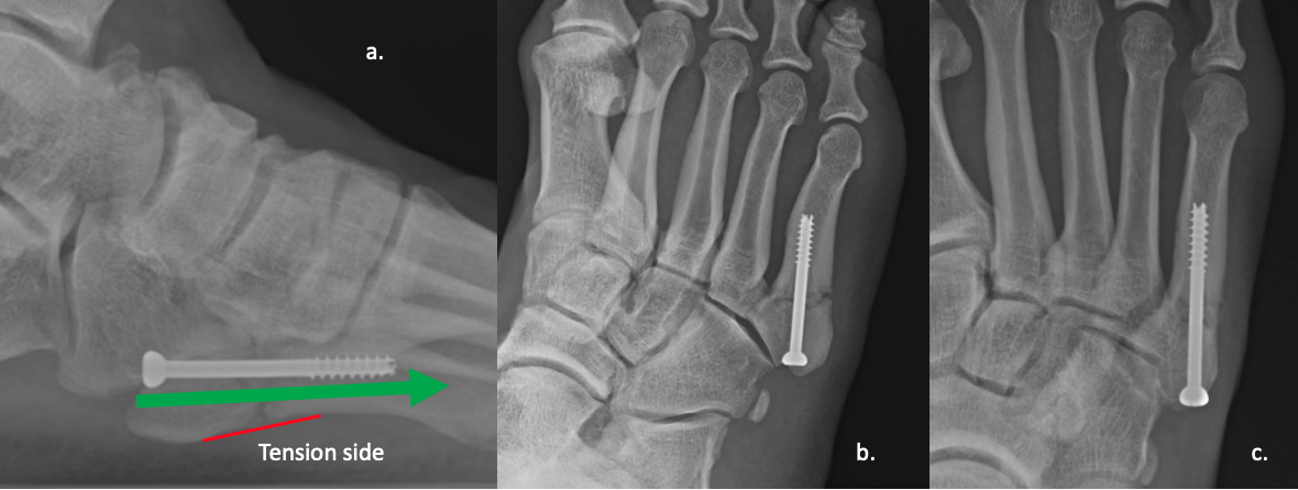 Figure 4. a. Clearly shows a poor positioned screw.&nbsp;The screw is too proximal and fails to make purchase with both sides of the intramedullary canal.&nbsp;As a result the fracture took significantly longer to heal because the screw failed to provide sufficient plantar tension side support. b-c. Although the screw is 4.5mm, this soldier’s canal needed a larger screw because the&nbsp;screw is barely purchasing.&nbsp;