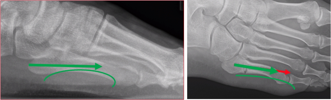 Figure 5.&nbsp;It is important to be cognizant of curved fifth metatarsals. The more curved the shaft is, the more careful you will need to be when deciding on screw lengths. Trying to force a longer screw will distract the fracture.