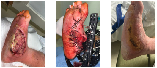 Patient 1. All 3 patients presented, including the one pictured here, had diabetes, rocker-bottom Charcot neuroarthropathy, and midfoot osteomyelitis.