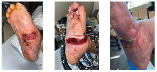 Patient 2. All patients in this series, like the one illustrated in these photos, developed a fibrous/bony union at their osteotomy sites.