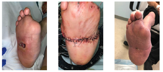 Patient 3. All patients at the conclusion of this series had a plantigrade foot with no signs of acute infection. All 3 can also ambulate in a custom ankle-foot orthosis at 12 months postop.