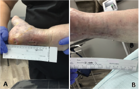 Figure 4. A) Achilles Tendon wound dehiscence B) Successfully closed wound within 12 weeks (Case 4)