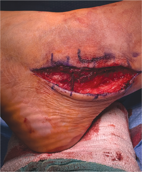 Figure 1. Final repair of the peroneal tendons, superior peroneal retinaculum, and augmentation over the retinaculum.