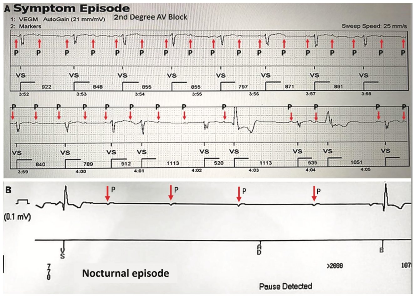 Pachon Cardioneuroablation Figure 1
