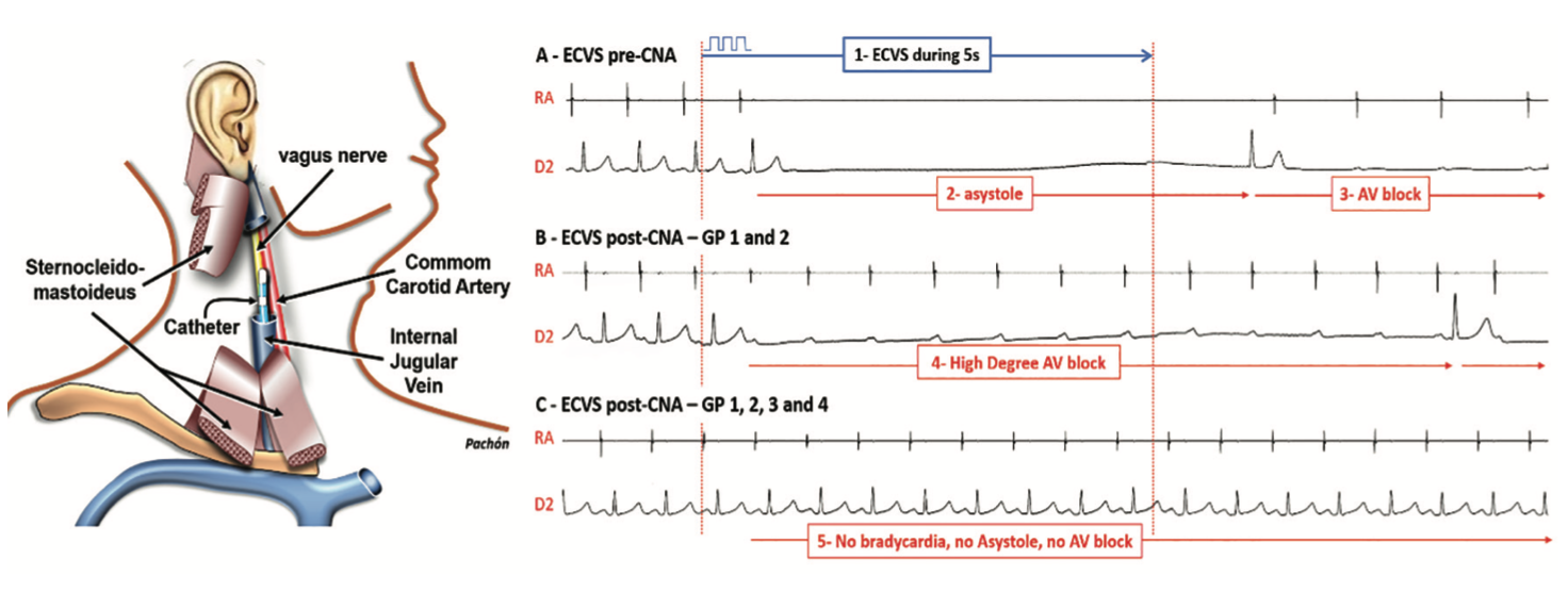 Pachon Cardioneuroablation Figure 3