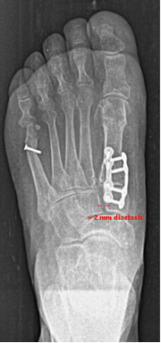 diastasis