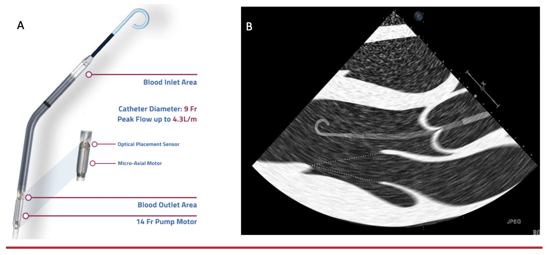 Panhwar Impella in AMI Complicated by CS Fig 1