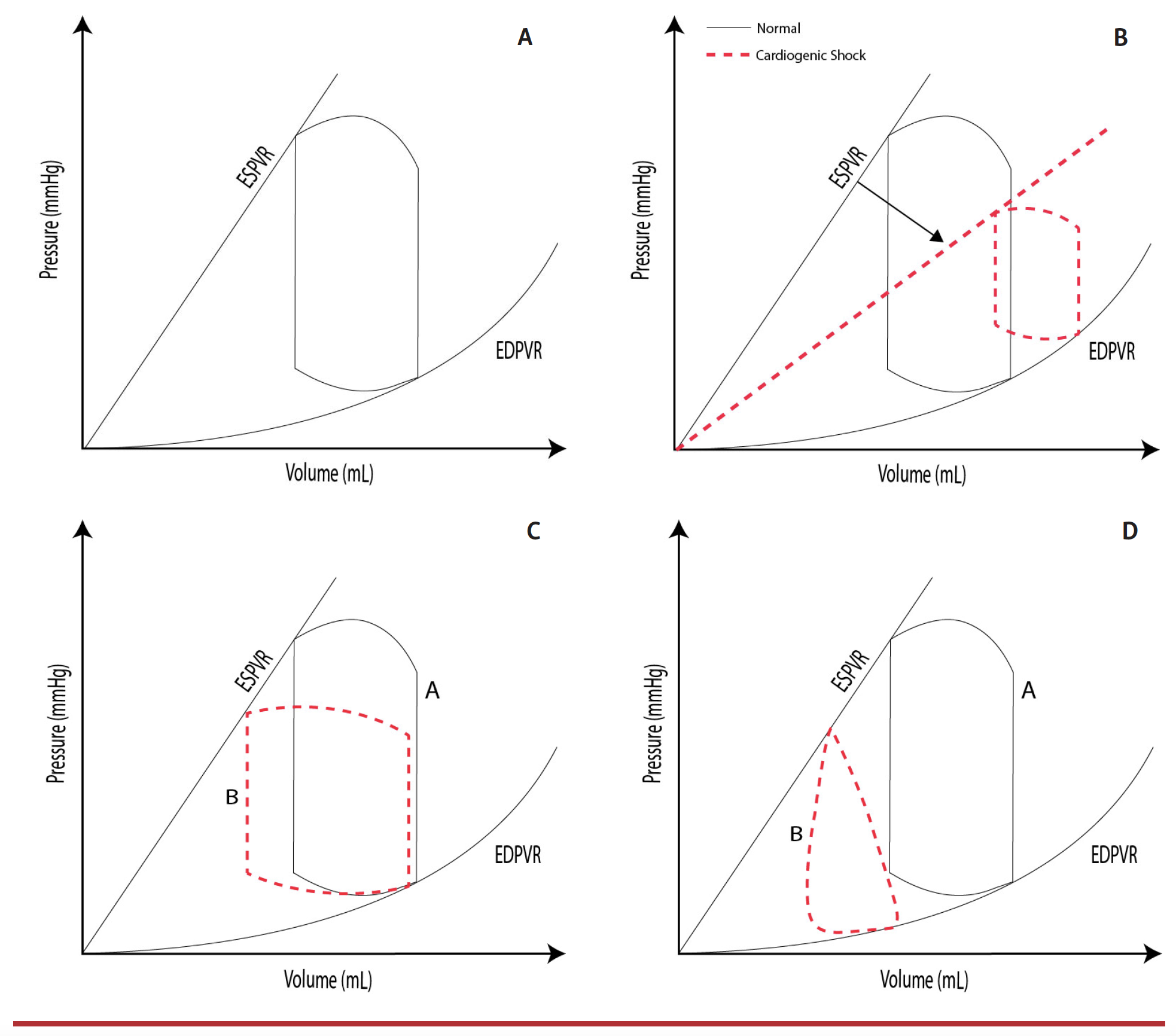 Panhwar Impella in AMI Complicated by CS Fig 2