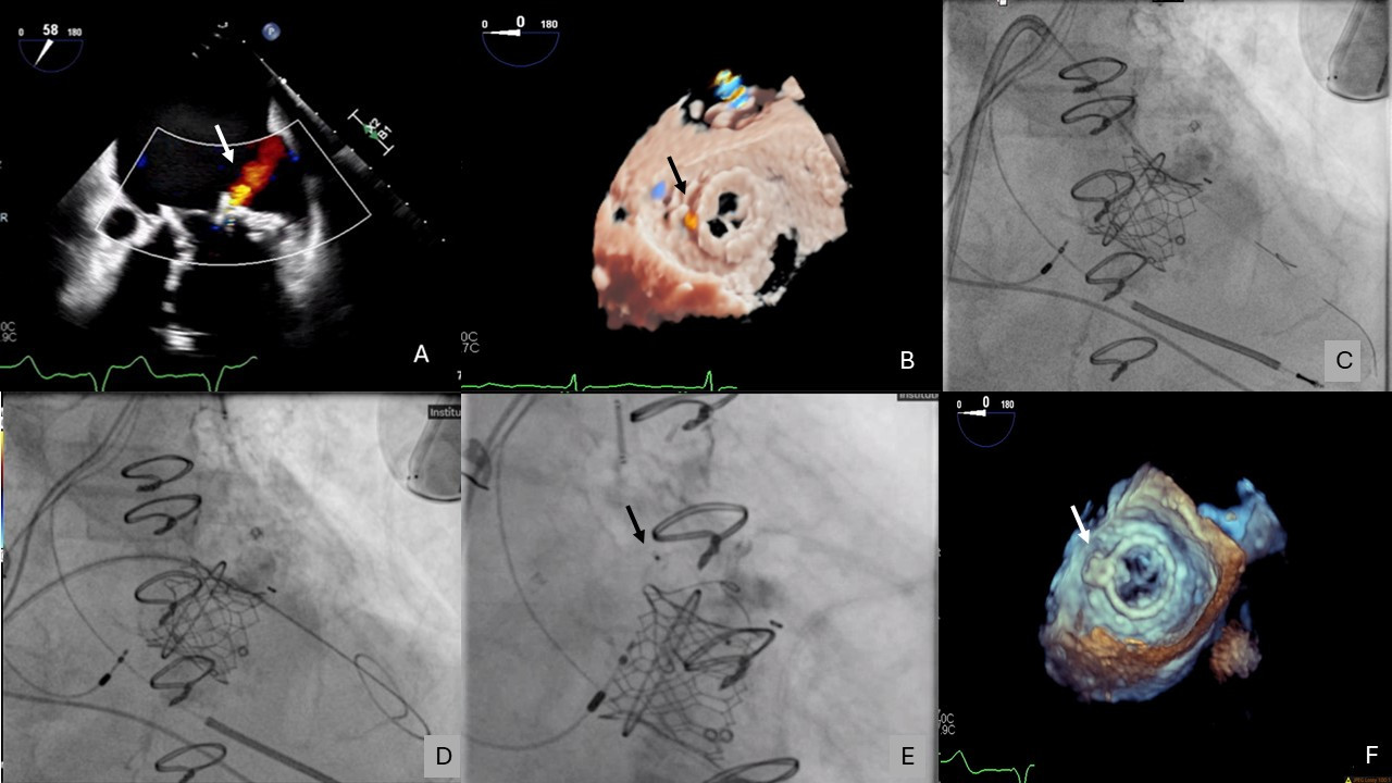 Figure. TEE demonstrated mitral paravalvular leak 