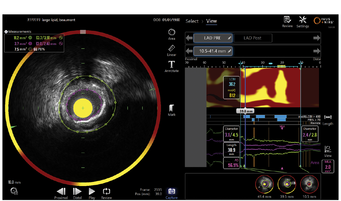 Figure 2. NIRS-IVUS of the LCx-OM2. (Left) Culprit lesion had a plaque burden of 78% and minimum lumen area (MLA) of 1.6 mm². (Right) Lipid core burden index (LCBI 4-mm segment) is 892. Additional lipid-rich plaque can be seen in the proximal LCx.