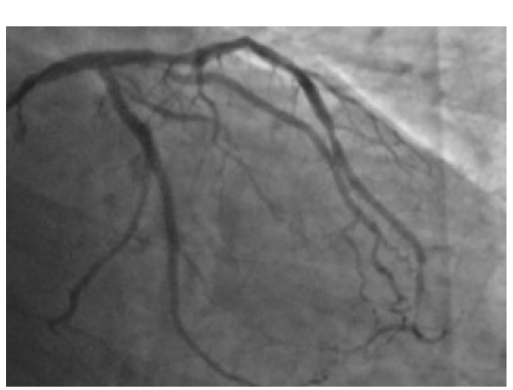 Figure 3. Post-PCI coronary angiography demonstrates no residual stenosis.