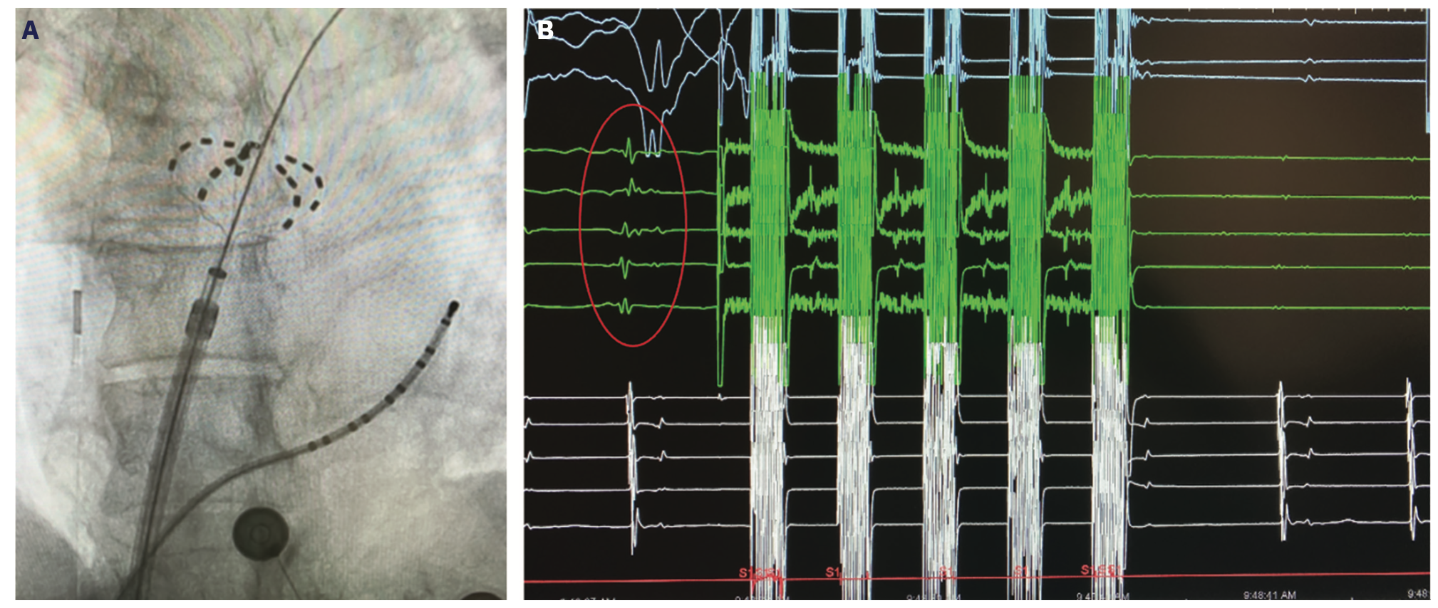 Patel Pulsed Field Ablation Figure 1