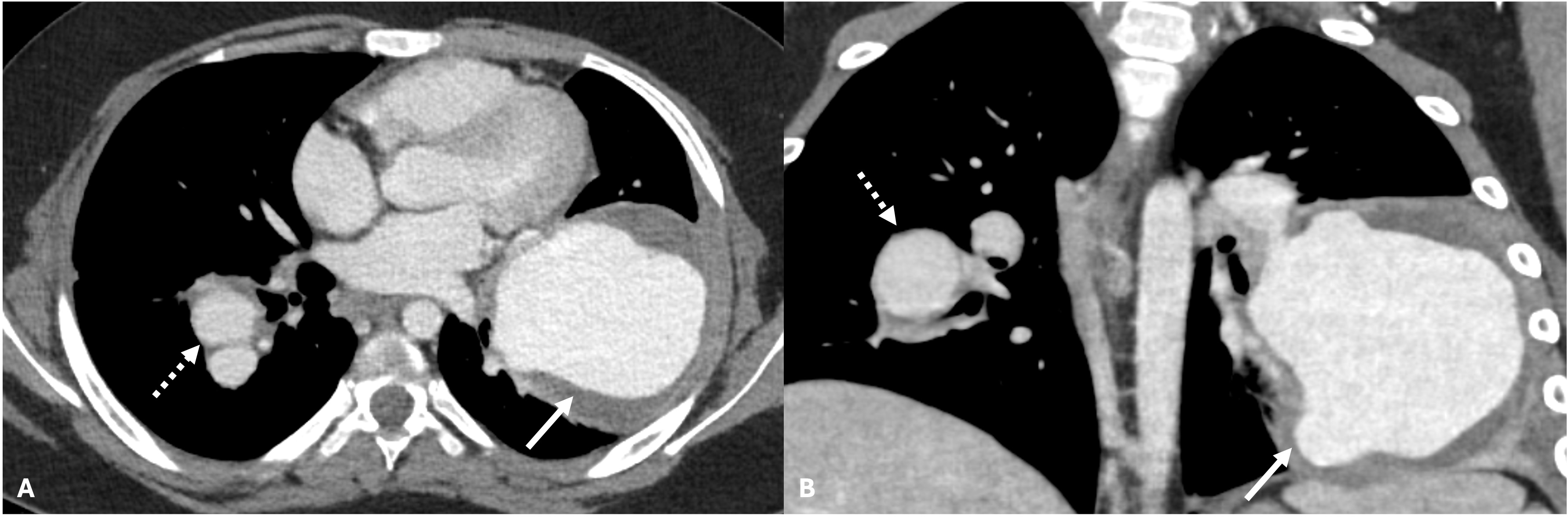 Figure 1. (A) Axial and (B) coronal computed tomography images