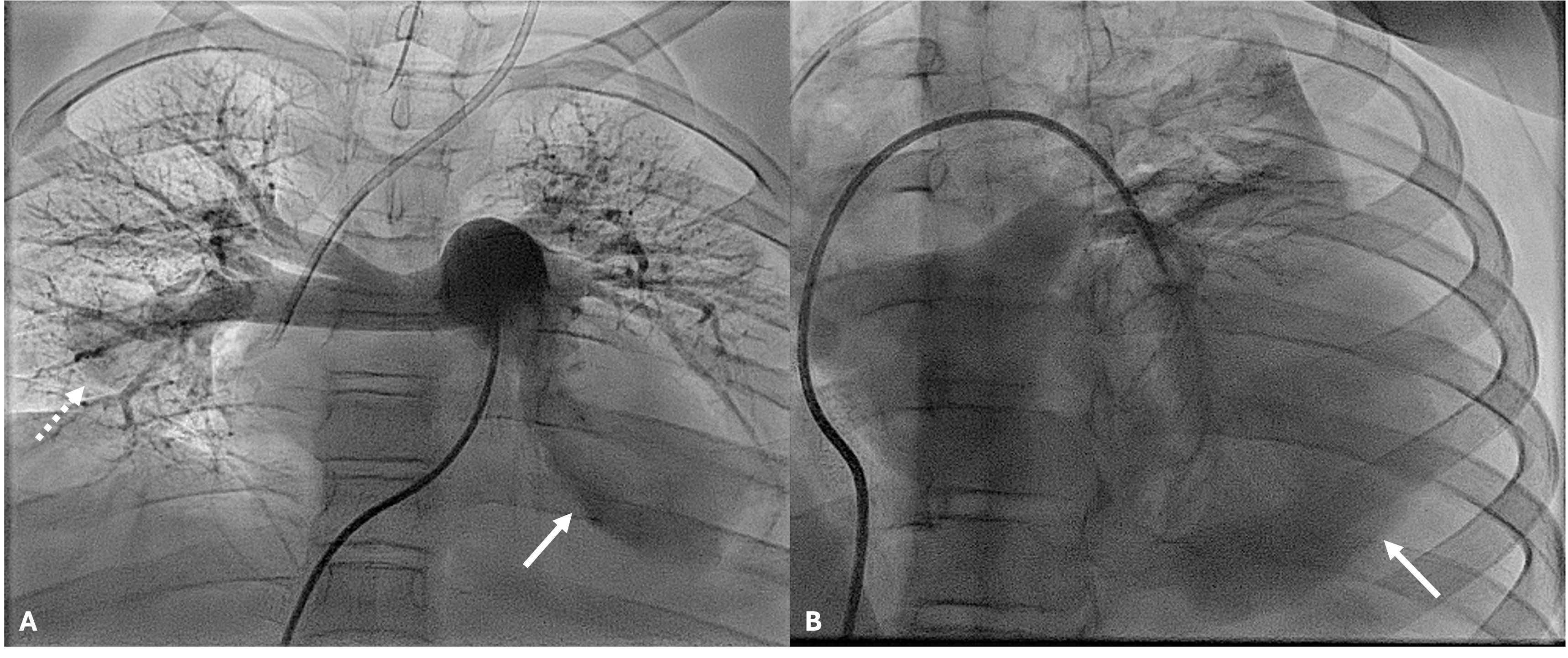 Figure 2. (A) Main and (B) left pulmonary artery angiography