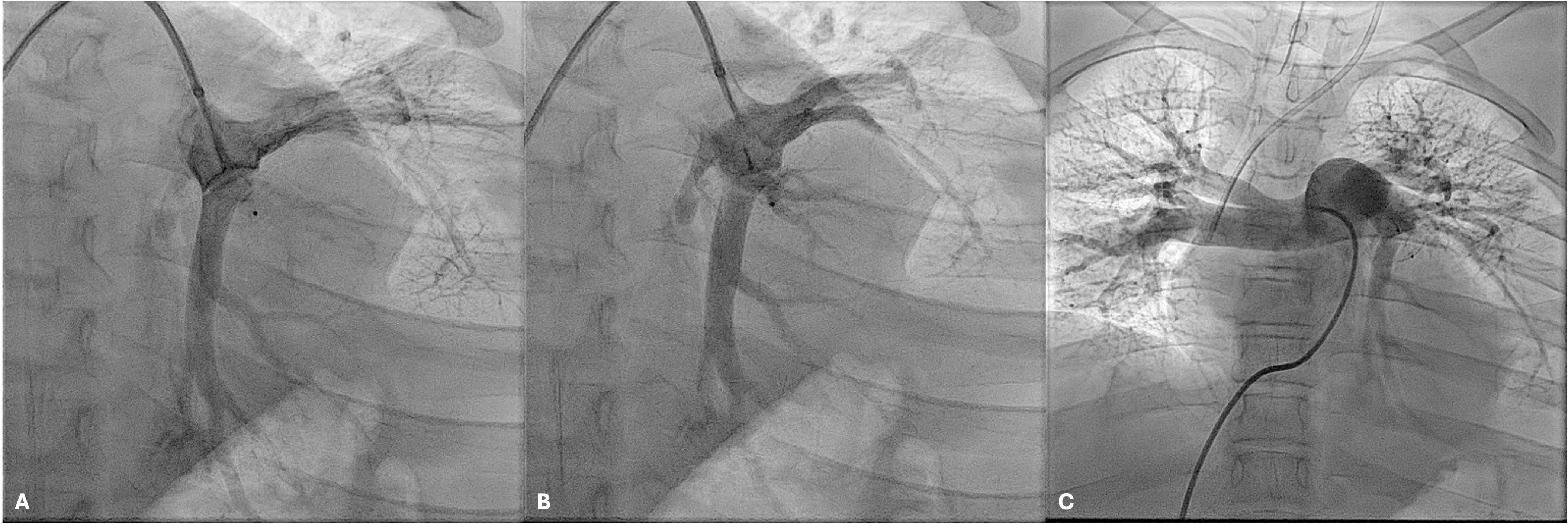 Figure 3. Angiograms showing (A) deployment of the 6/6 Amplatzer Duct Occluder (ADO) II