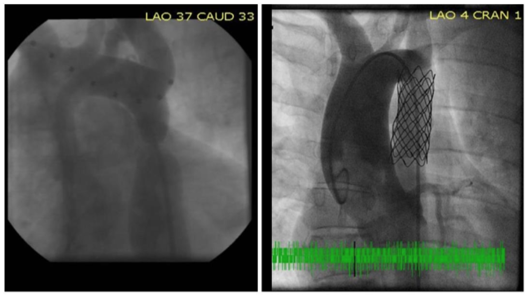 Pei Intravascular Stent Therapy Figure C
