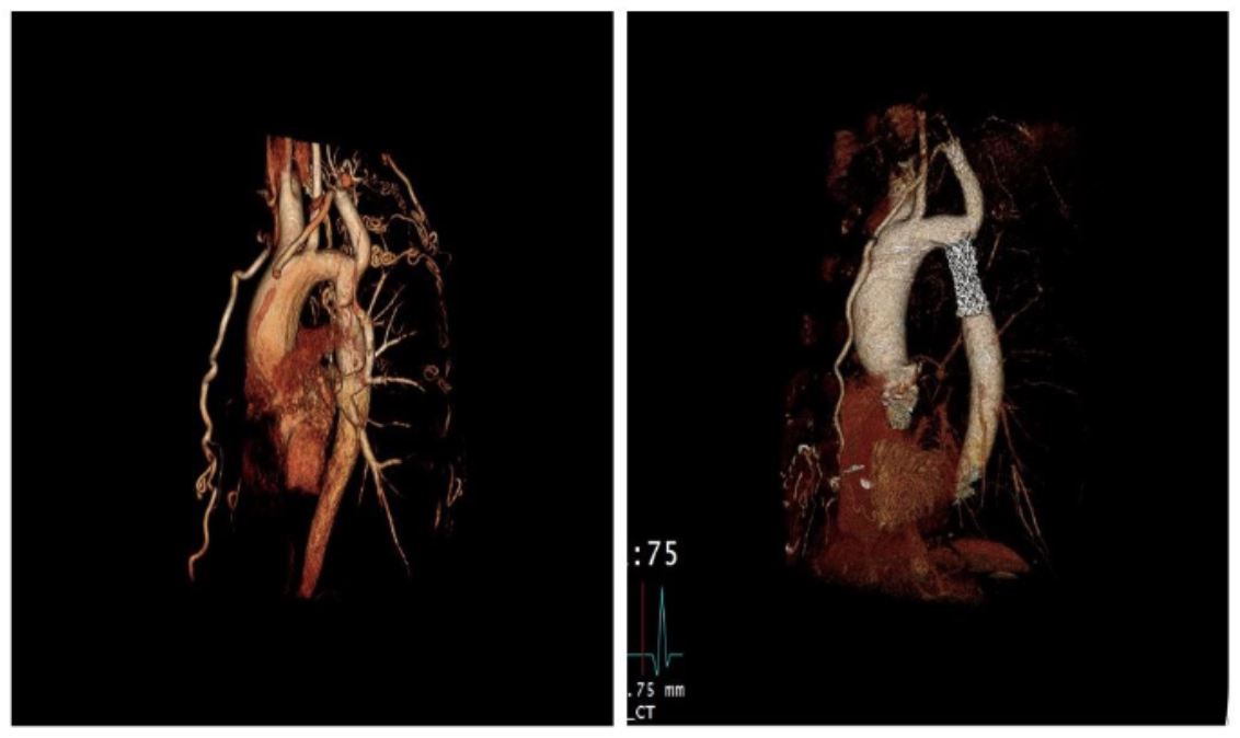 Pei Intravascular Stent Therapy Figure D
