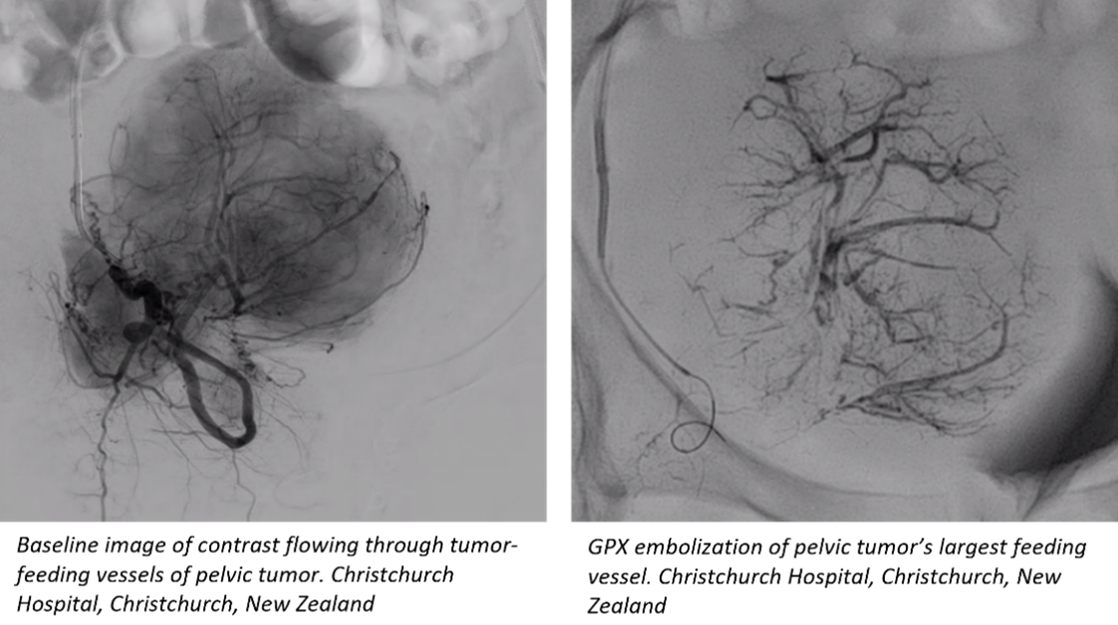 FluidRx Pelvic Tumor