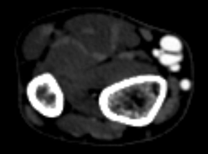 Figure 2. Axial cut of computed tomography angiogram of radial artery communicating with cephalic artery via pseudoaneurysm.