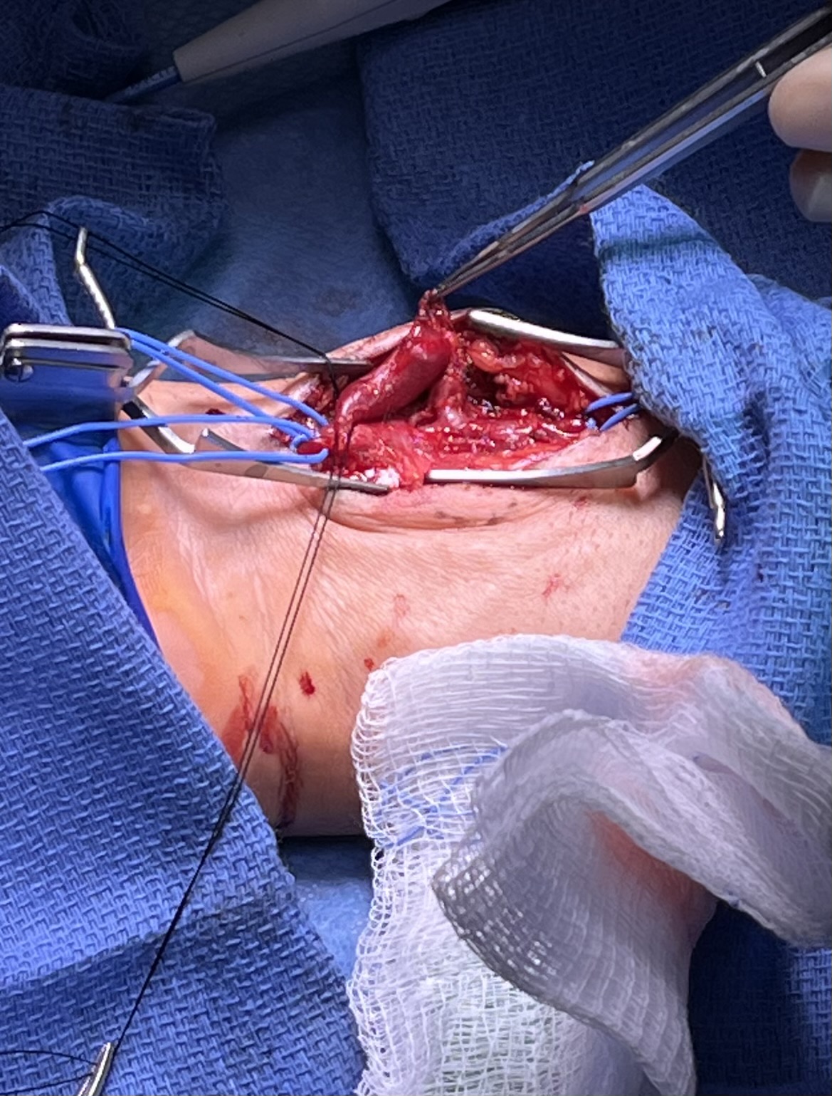 Figure 3. Intraoperative clinical image of aneurysmal sac, isolated.