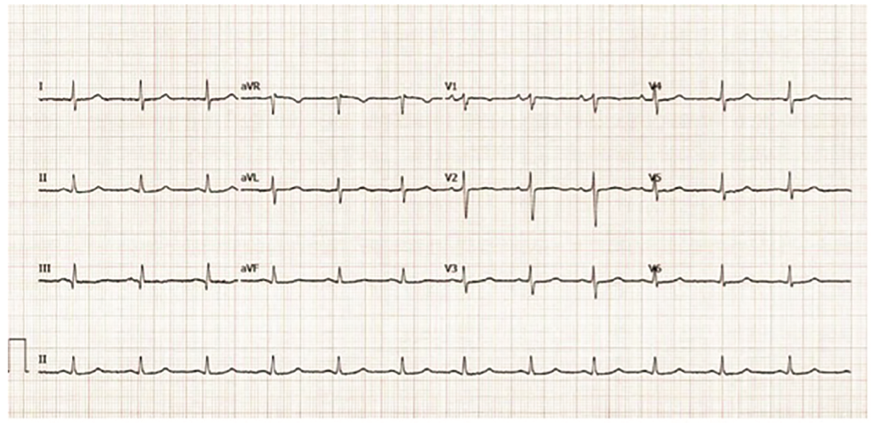 Phang Ablation Figure 1E
