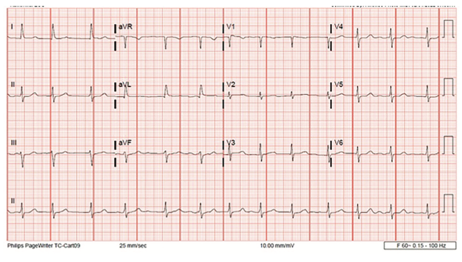 Phang Ablation Figure 2A
