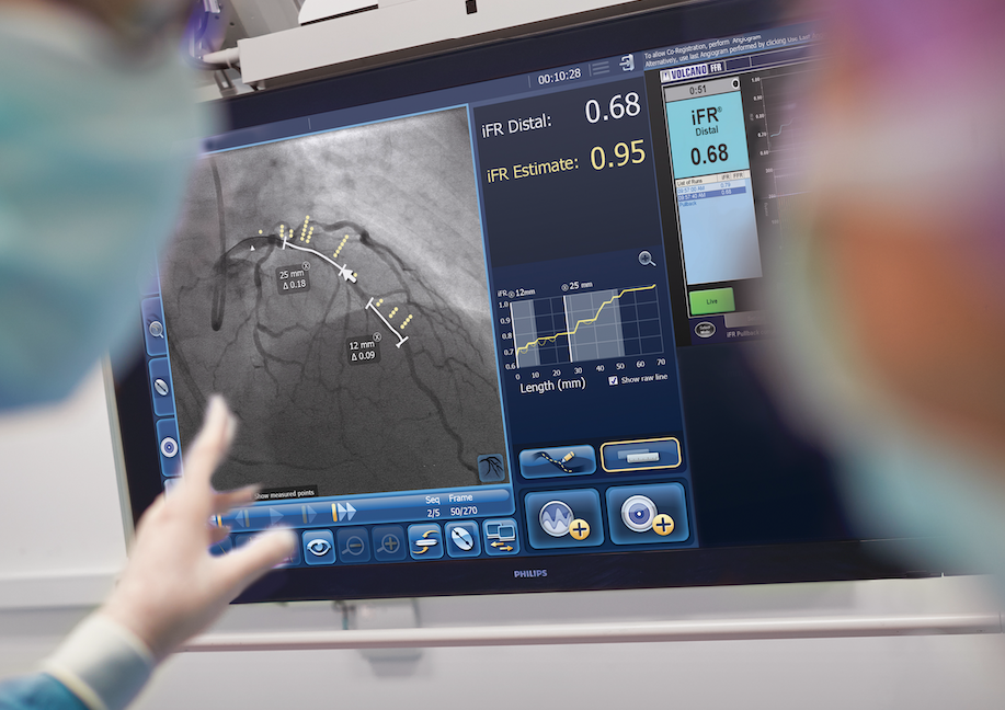 Philips instantaneous wave-free ratio (iFR)  2