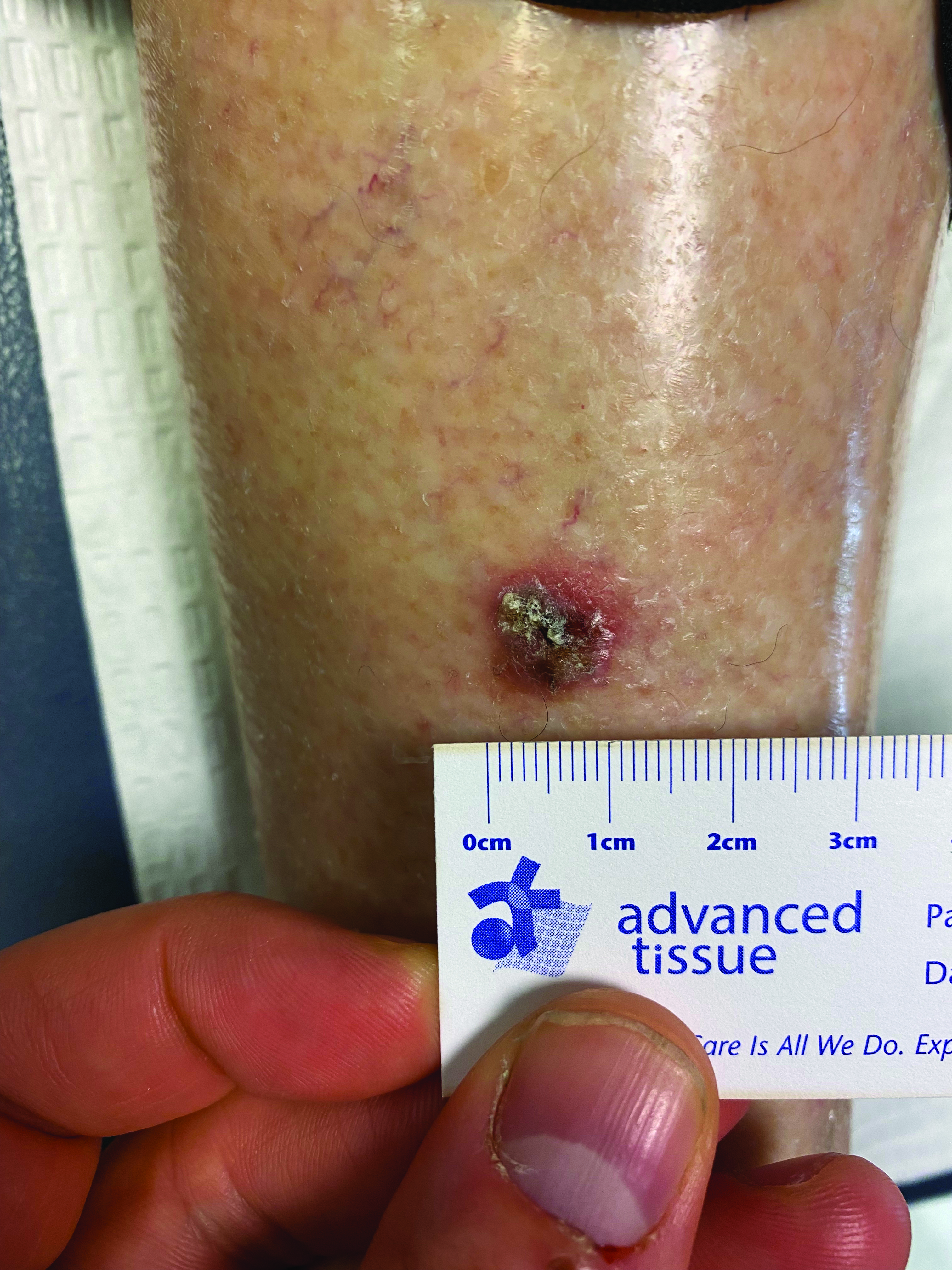 In this photo, one can see the lesions upon initial presentation. Although the patient could not provide a comprehensive history, her daughter related their presence over at least 2 years, with notable changes occurring over the past few week.