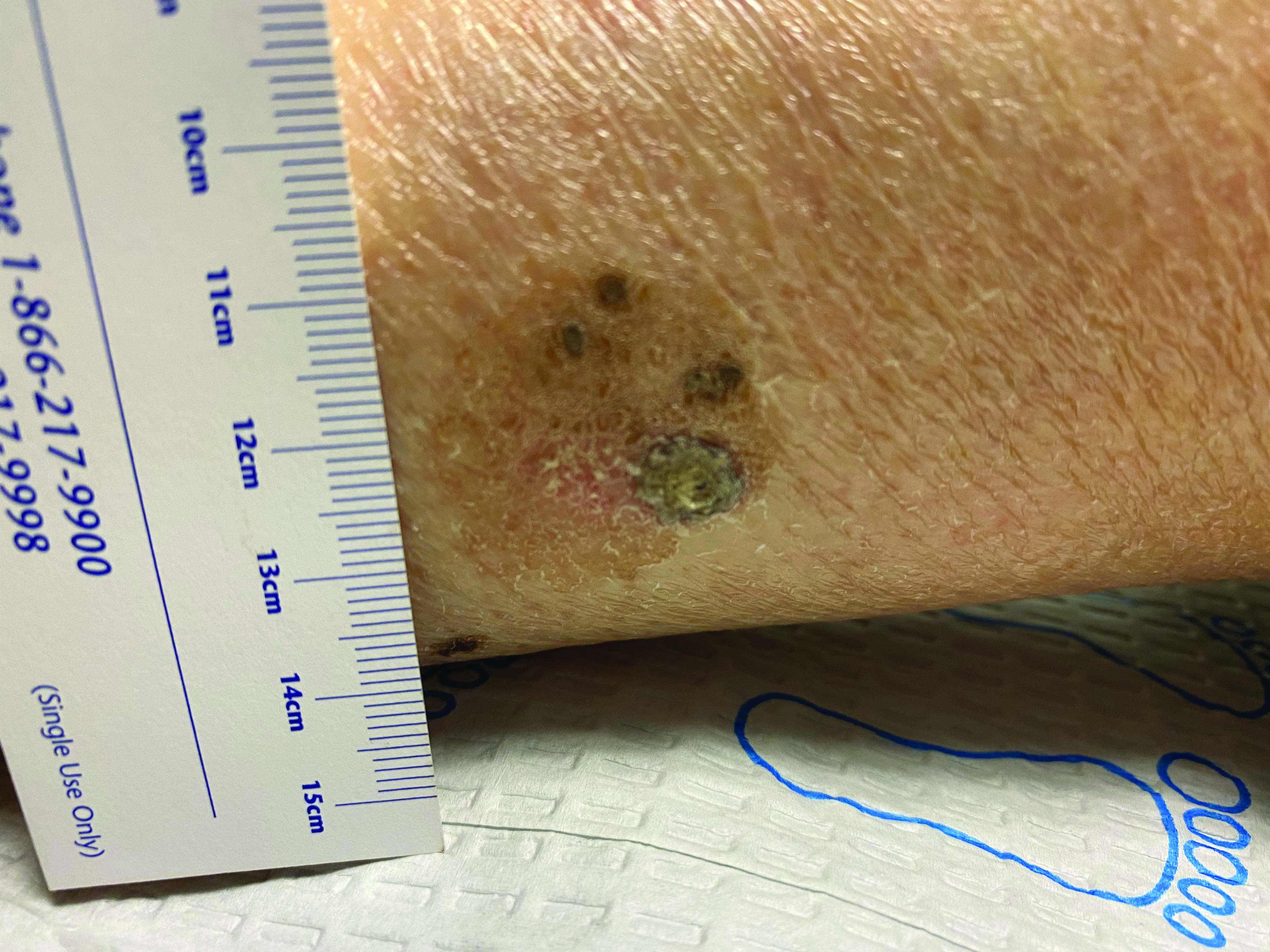 In this photo, one can see the lesions upon initial presentation. Although the patient could not provide a comprehensive history, her daughter related their presence over at least 2 years, with notable changes occurring over the past few weeks.