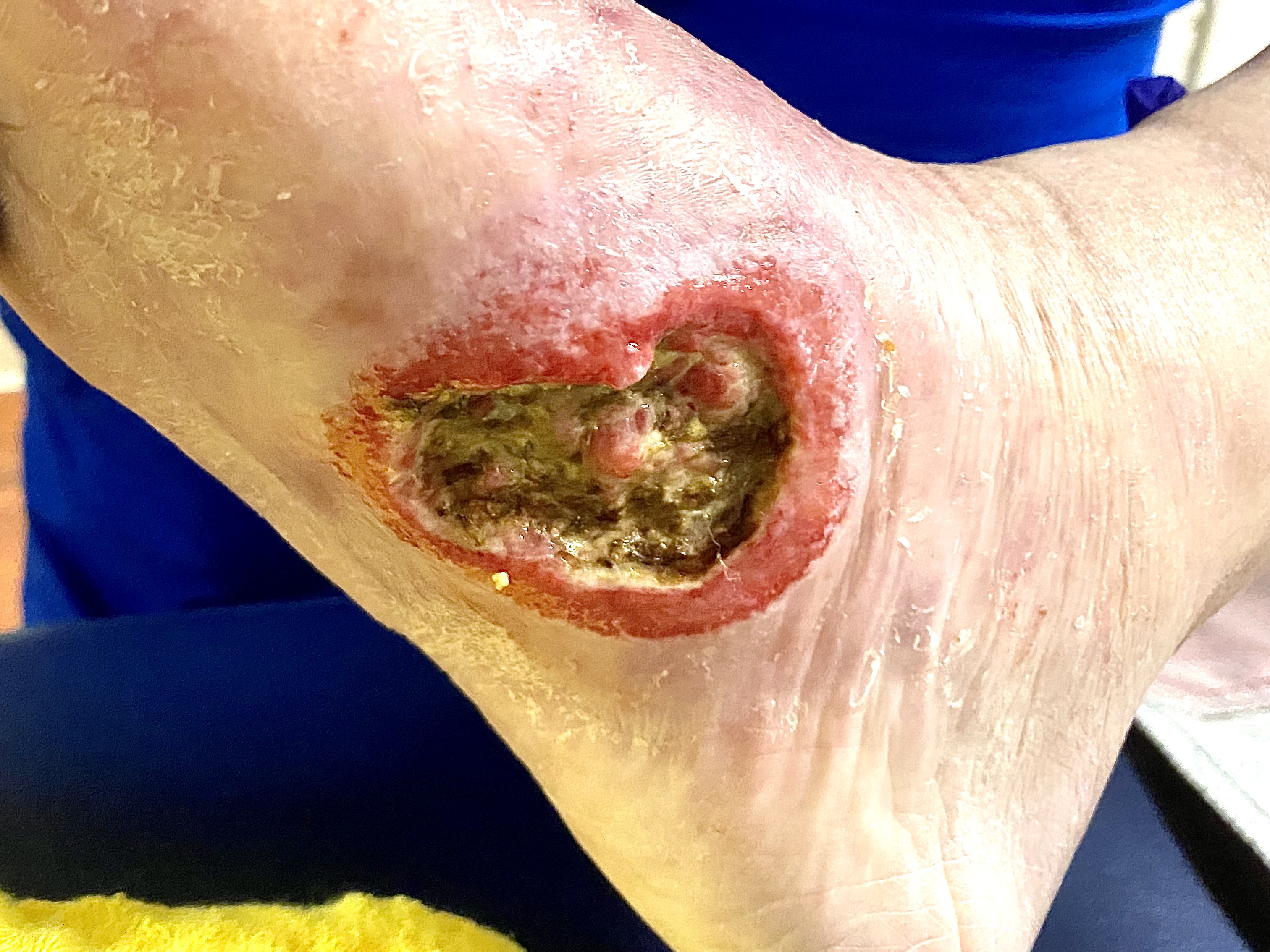 Woringer-Kolopp Disease