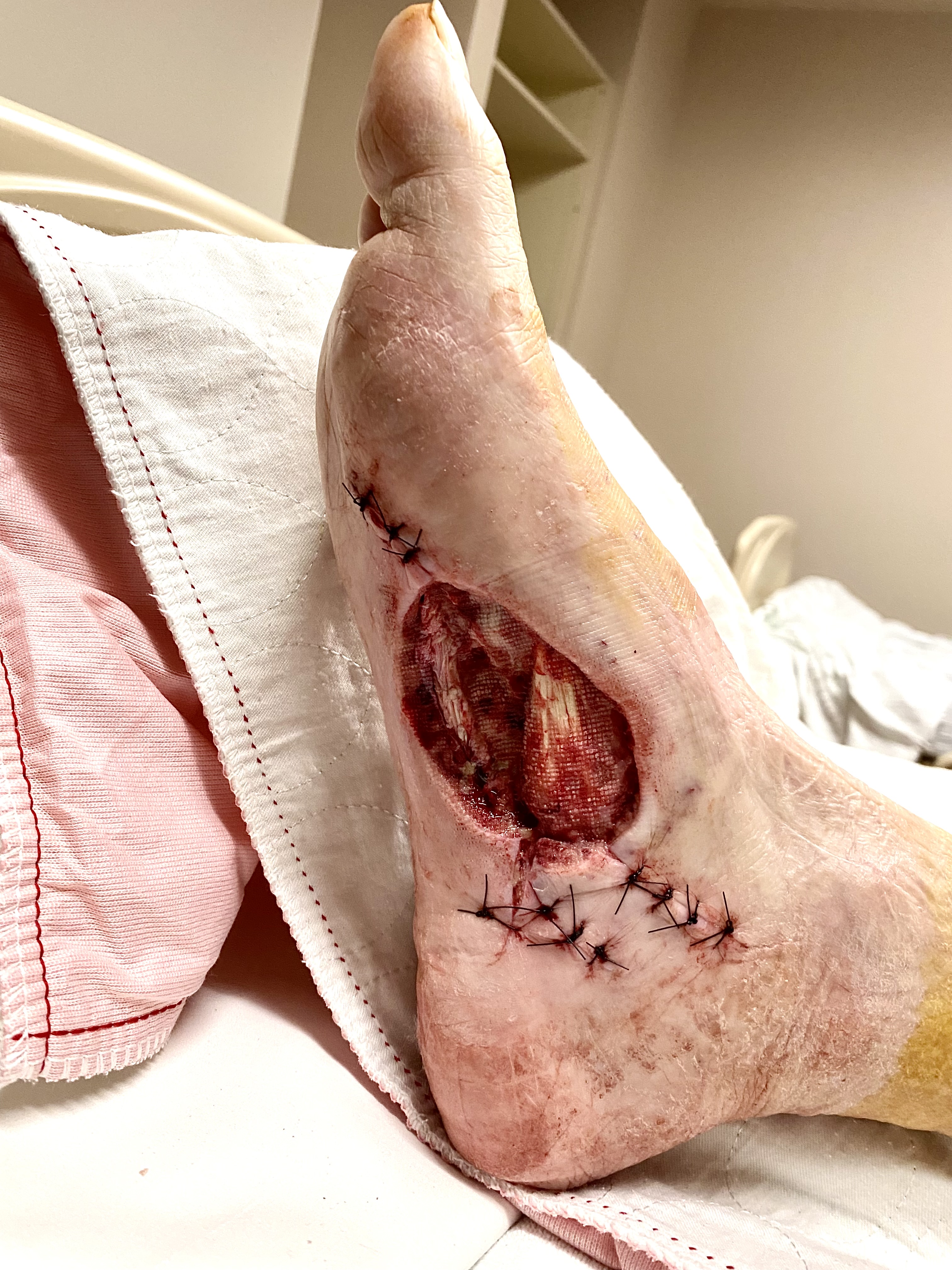 Woringer-Kolopp Disease