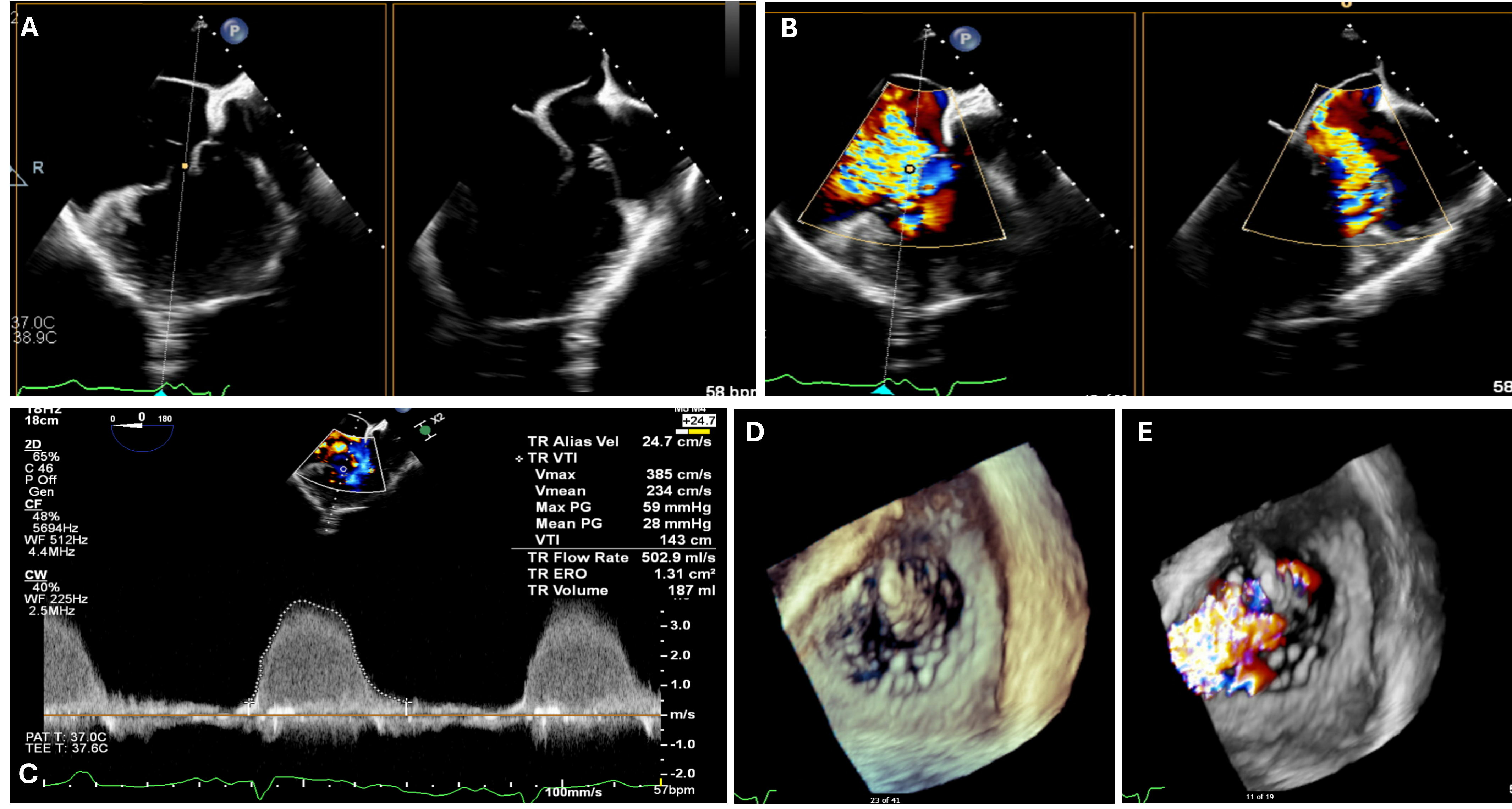 Figure 1. Baseline echocardiographic images leading to torrential regurgitation, (C) effective regurgitation orifice, and (D, E) 3-dimensional reconstruction.