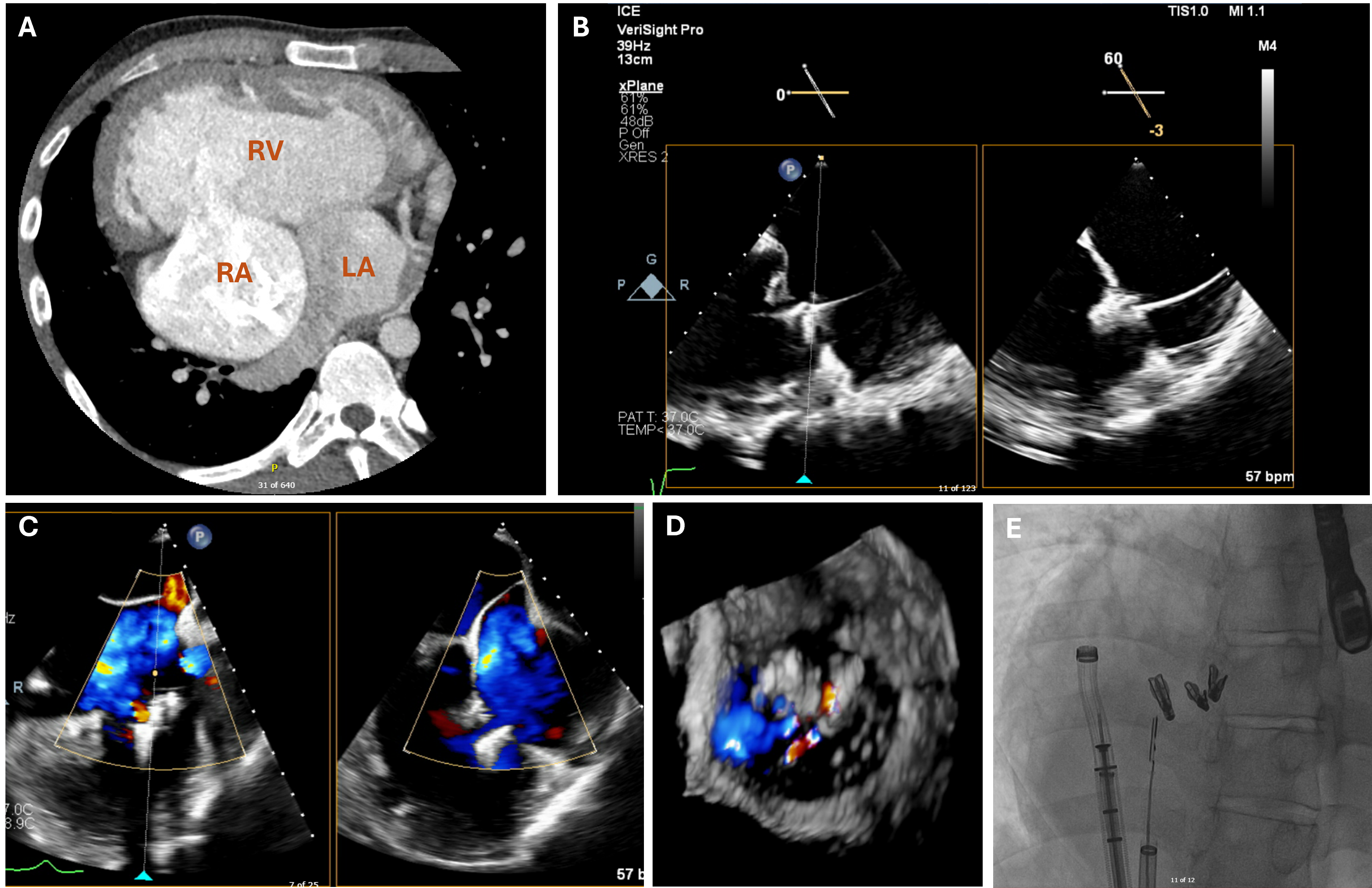 Figure 2. Transcatheter edge-to-edge repair procedure