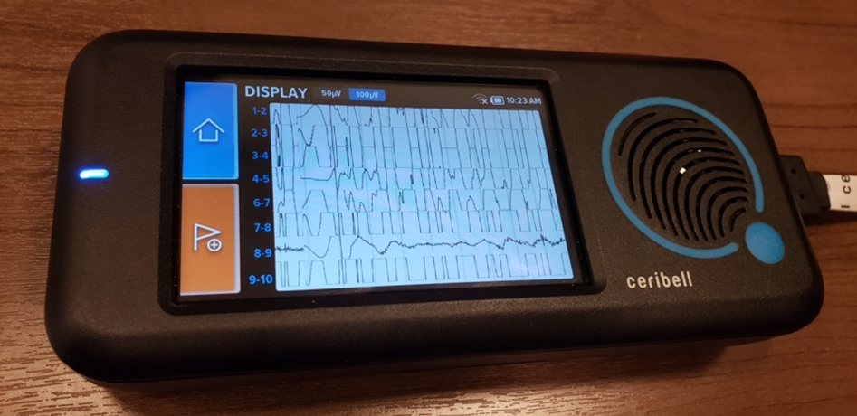 The Ceribell device even has a screen that lets you see the actual EEG in real time.