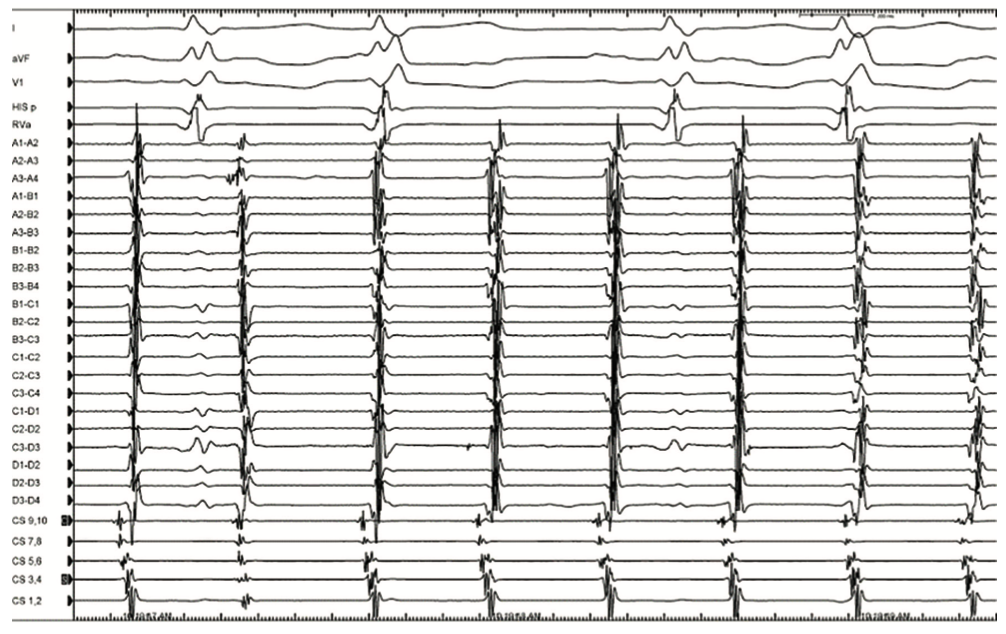 Pillari Atypical Atrial Flutter Figure 2
