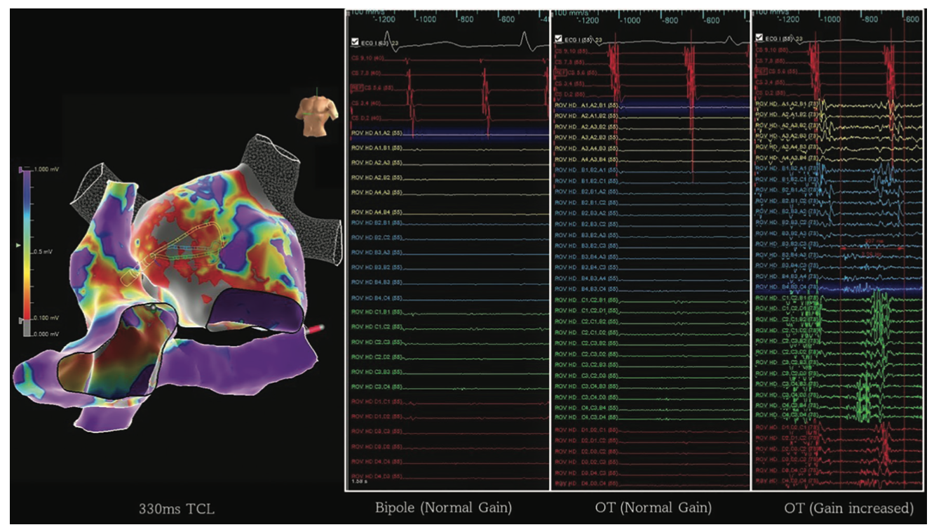 Pillari Atypical Atrial Flutter Figure 5